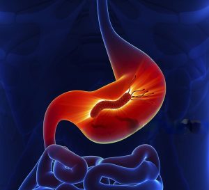 Estomago com H pylori.
